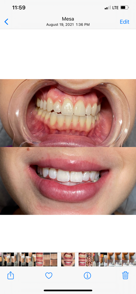 Teeth Whitening