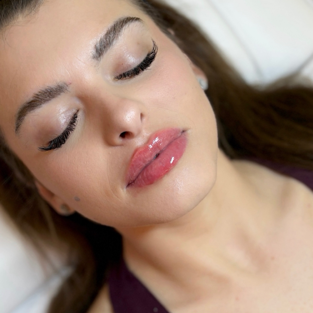 RHA® 3 Lip Filler✨ at The Skin Room Med Spa in Marshall, TX