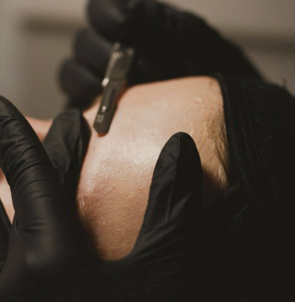 dermaplaning facial