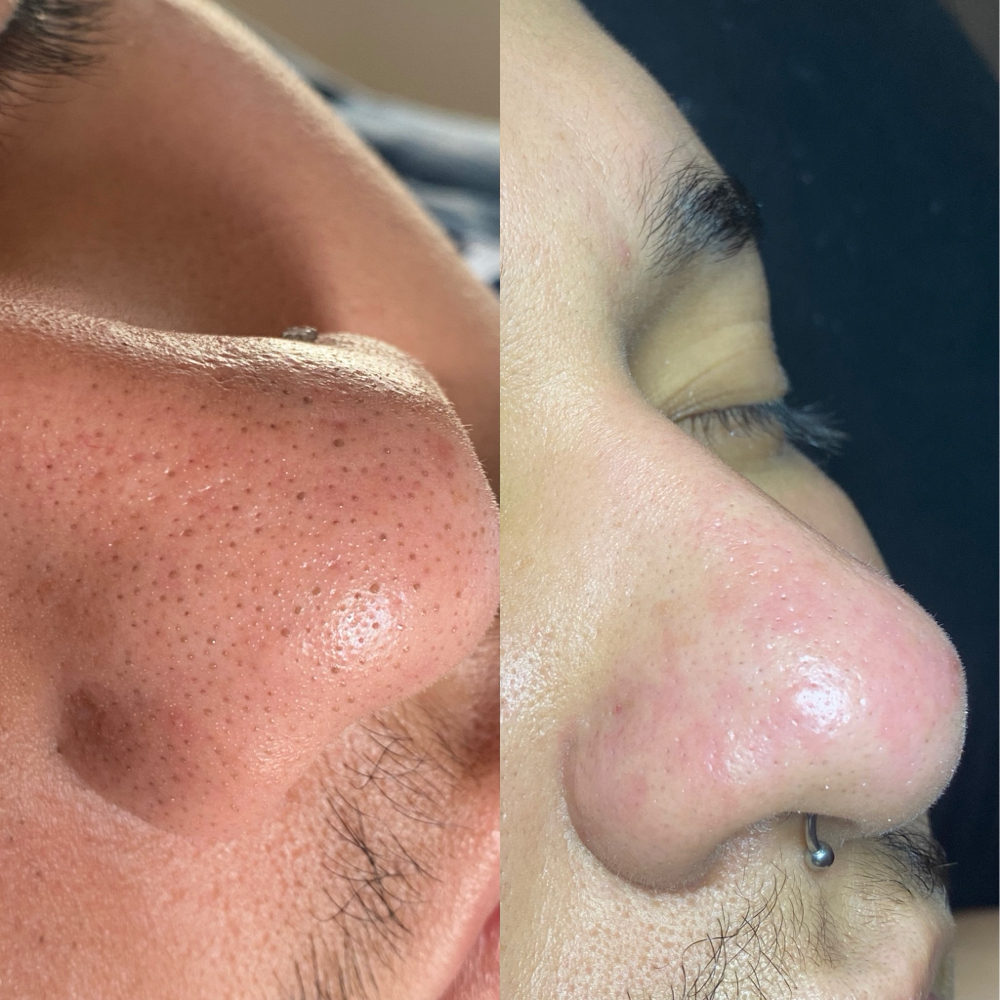 Detox Facial