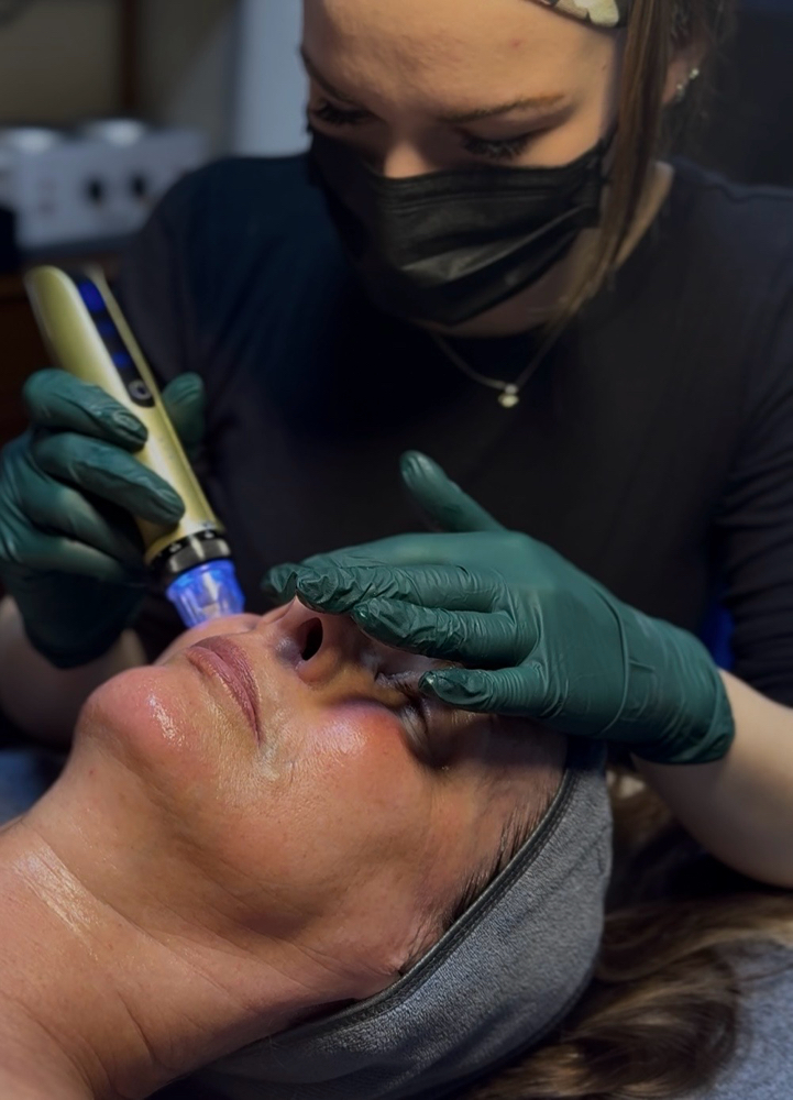 Microneedling at MadSkin Esthetics in Colorado Springs, CO