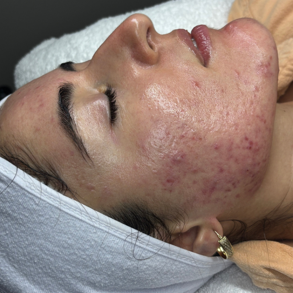 The Clear Skin Facial at Ruby Williams Aesthetics LLC in Sarasota, FL