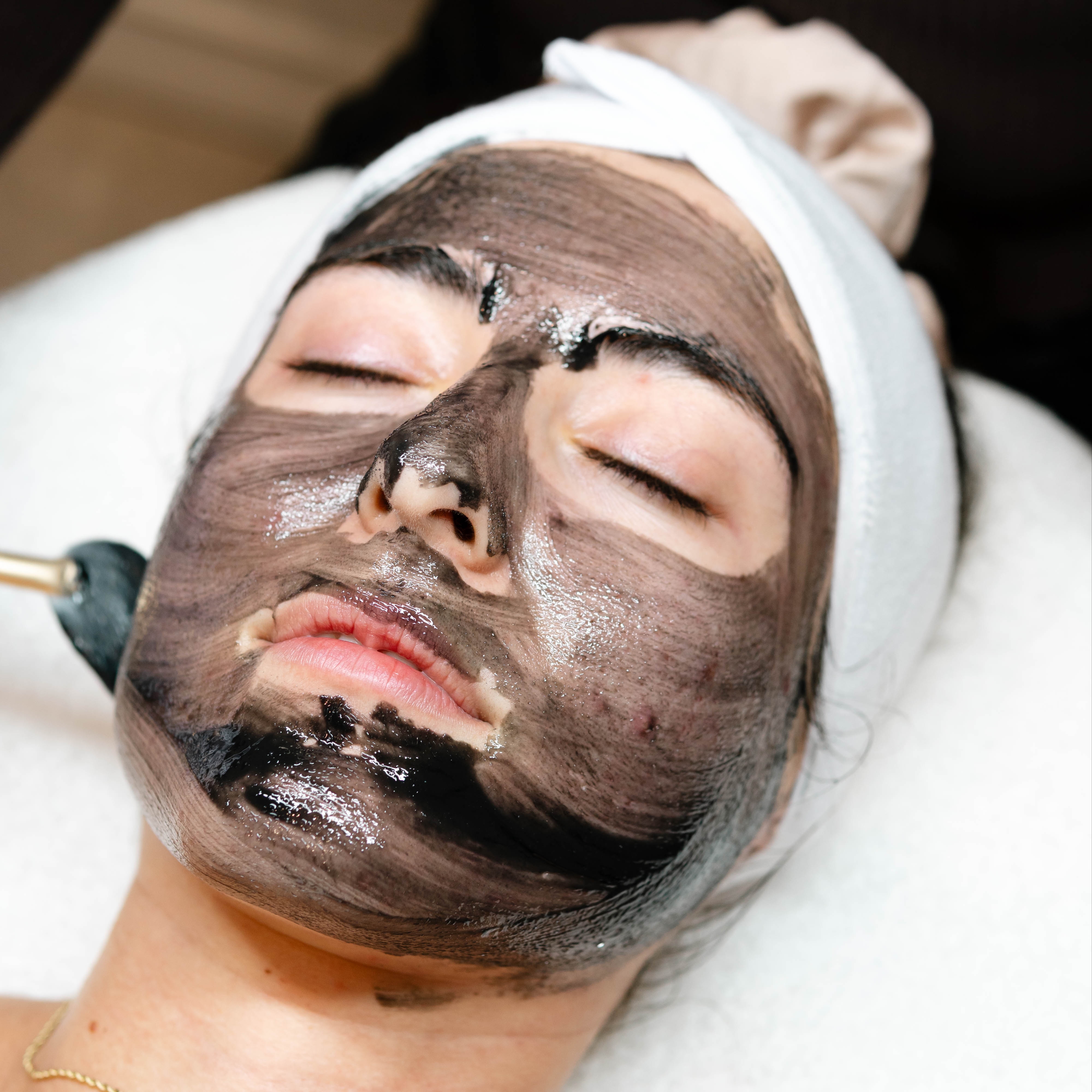 The Acne Facial at Ruby Williams Aesthetics LLC in Sarasota, FL