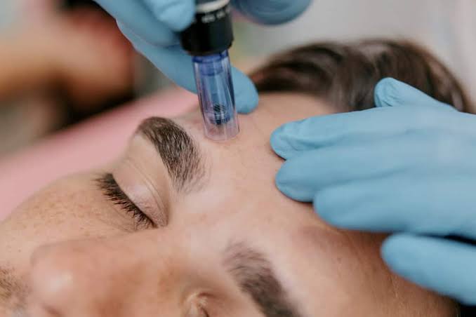 Microneedling Face & Neck