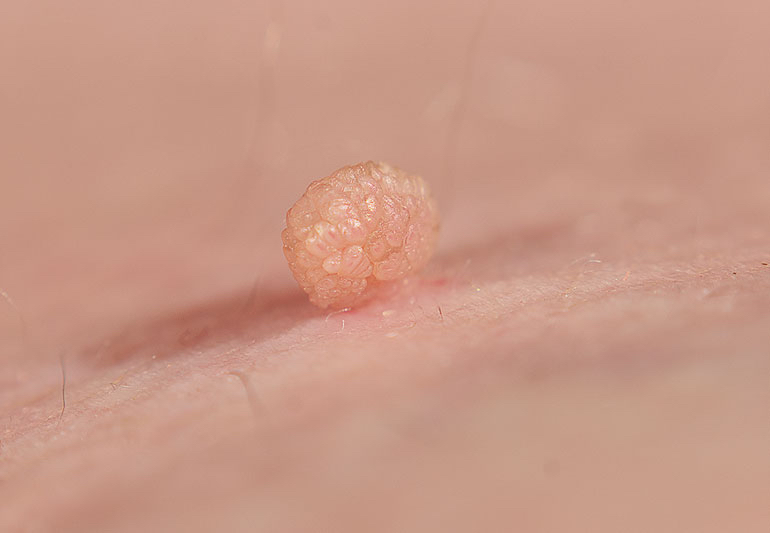 Skin Tag Removal