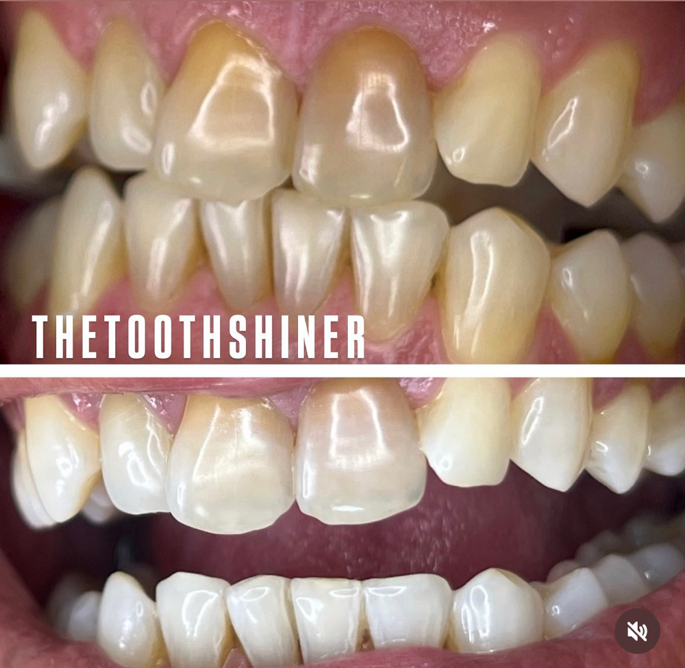 THE TOOTH SHINER DELUXE