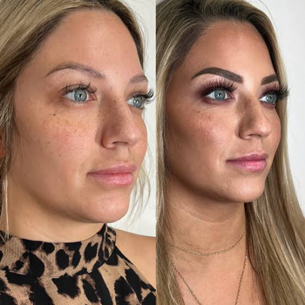 Full Facial Balancing at Refyned Aesthetics & Wellness in Greenville, TX
