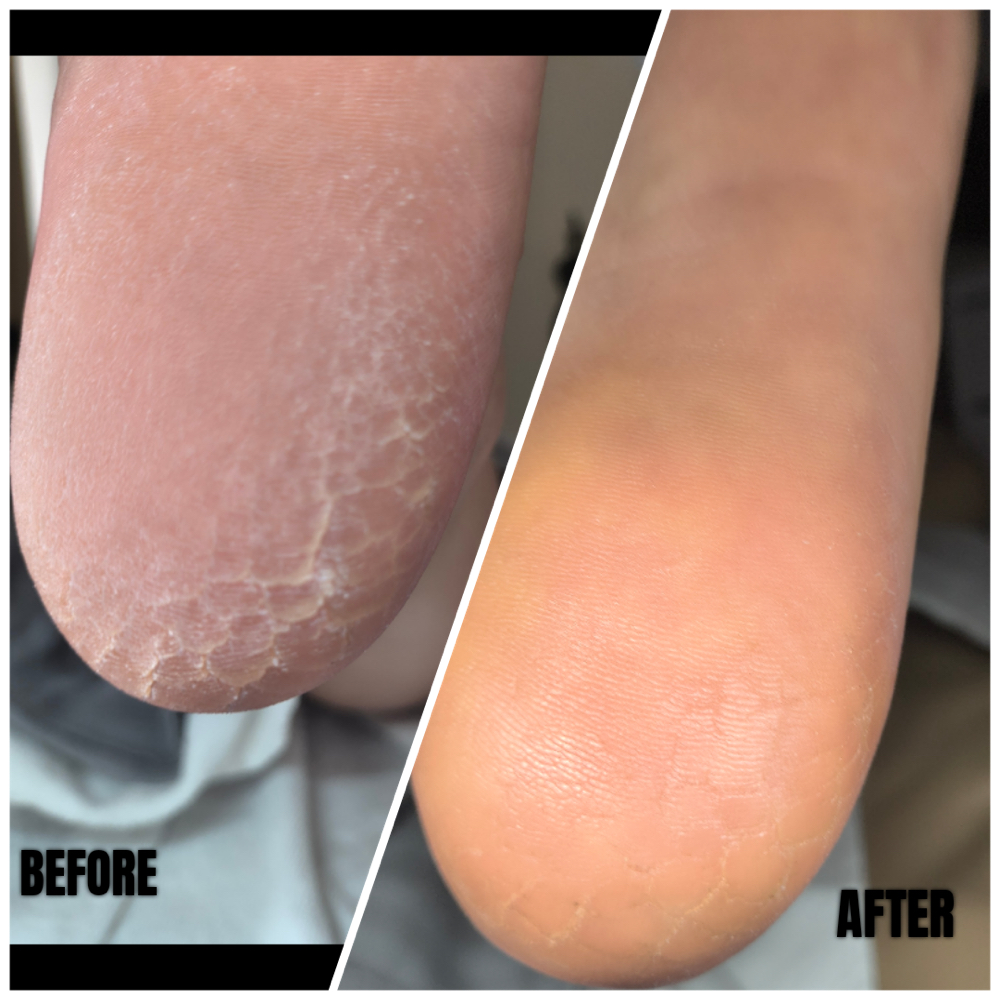 Callus Orange Pell Treatment at Lombard Nail Spa in San Francisco, CA