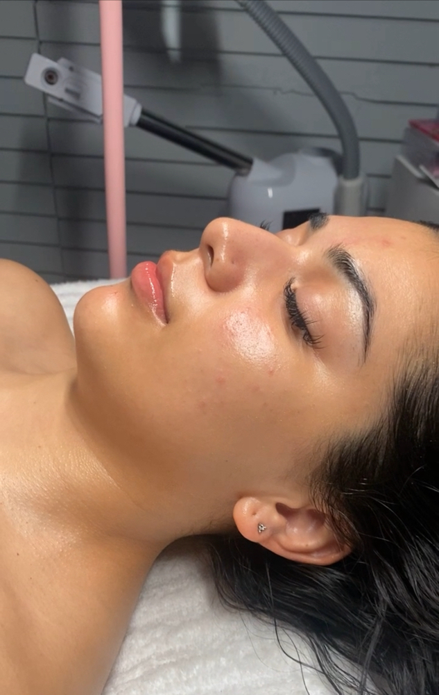 Acne Facial