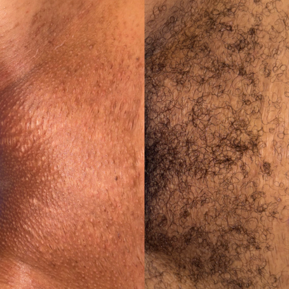 Brazilian Wax at Tesoro Luxe Aesthetics in San Antonio, TX
