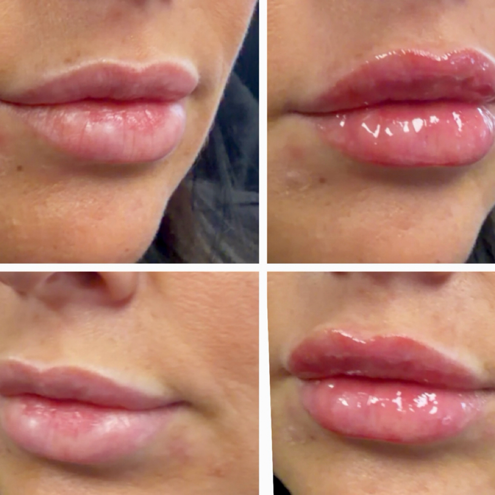 Lip Filler And More at Southern Sparkle Medical Aesthetics in Swainsboro, GA