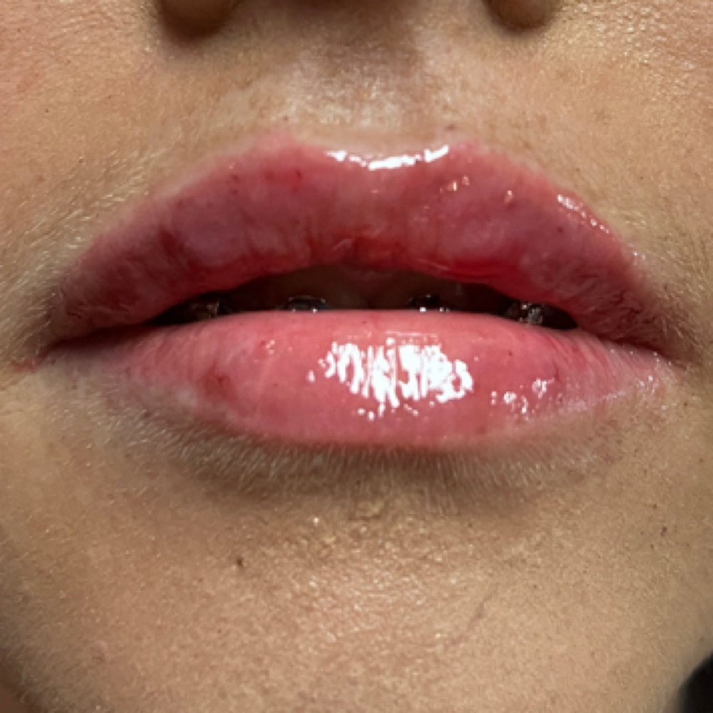 Lip Filler And More at Southern Sparkle Medical Aesthetics in Swainsboro, GA