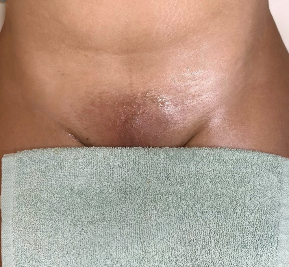 Sugar Brazilian at The Custom Aesthetic in San Diego, CA