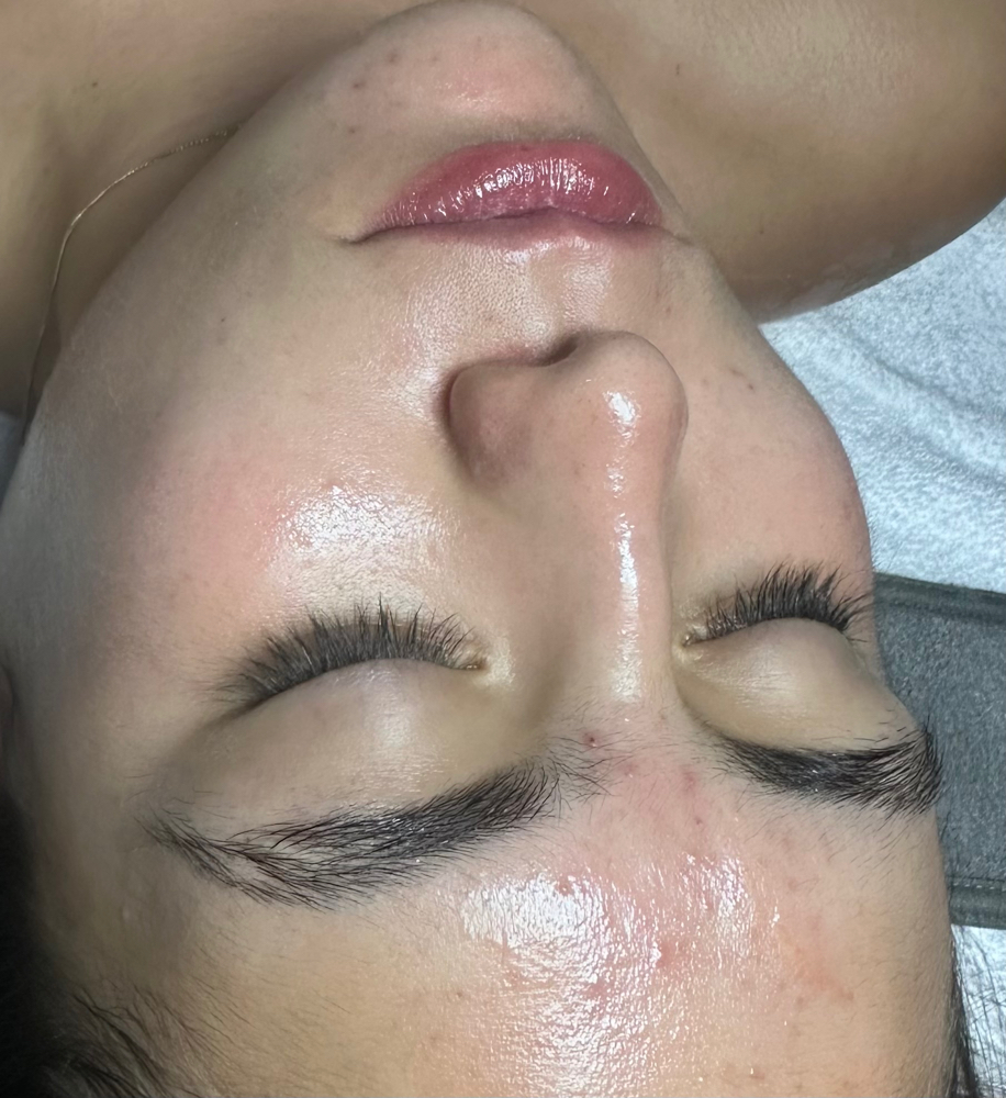 Acne Control Facial