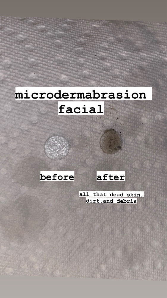 Microdermabrasion Facial