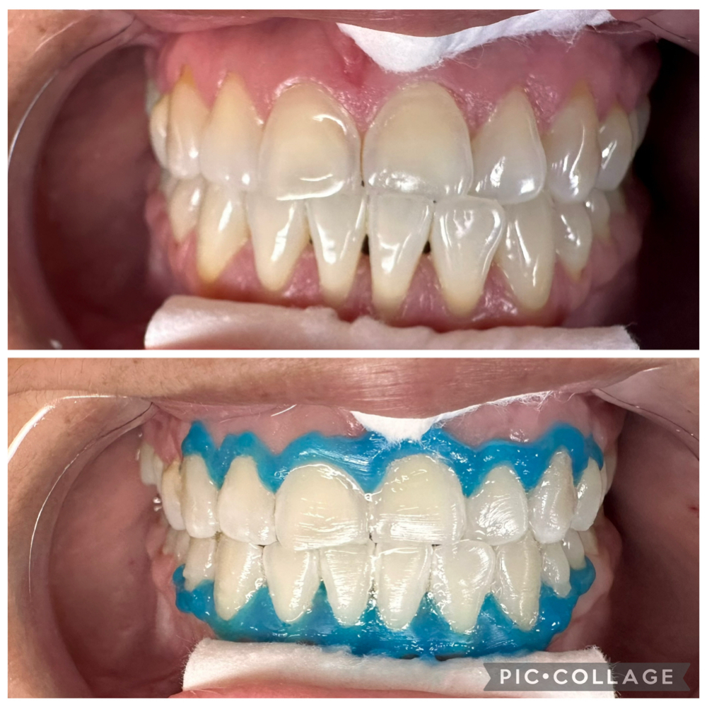 80 minute Teeth Whitening at House of Esthetics LLC in Casa Grande, AZ
