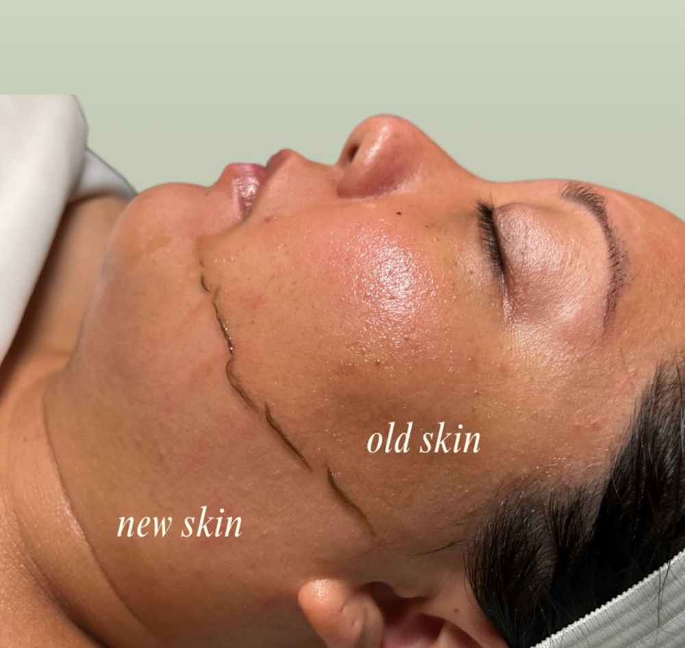 Dermaplaning Facial