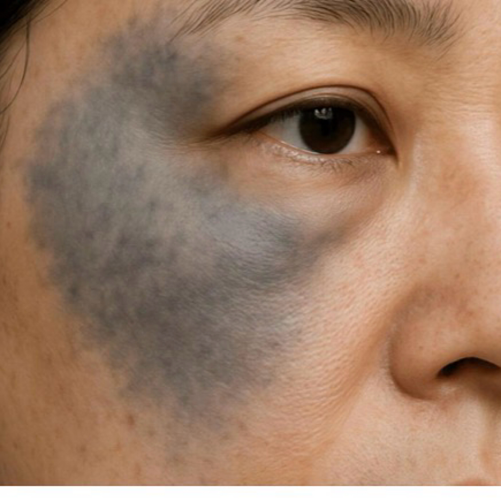 Nevus Of Ota (6) at La Belle Studio by Soraya in Woburn, MA