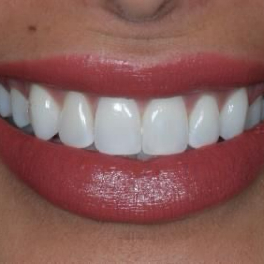 Whitening Touch Up at The Whitening Shop in Virginia Beach, VA