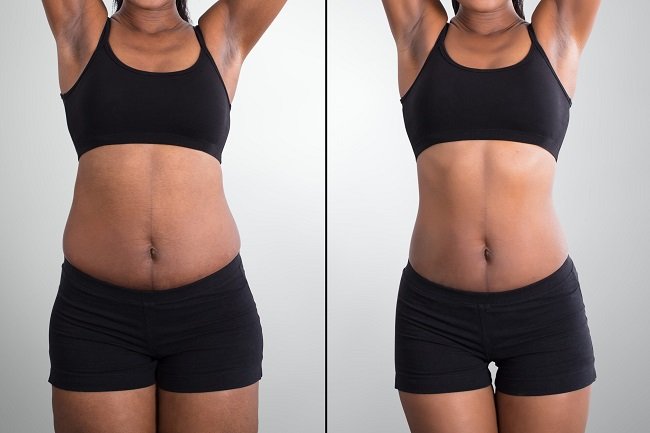 Ultrasonic Cavitation (6TX)