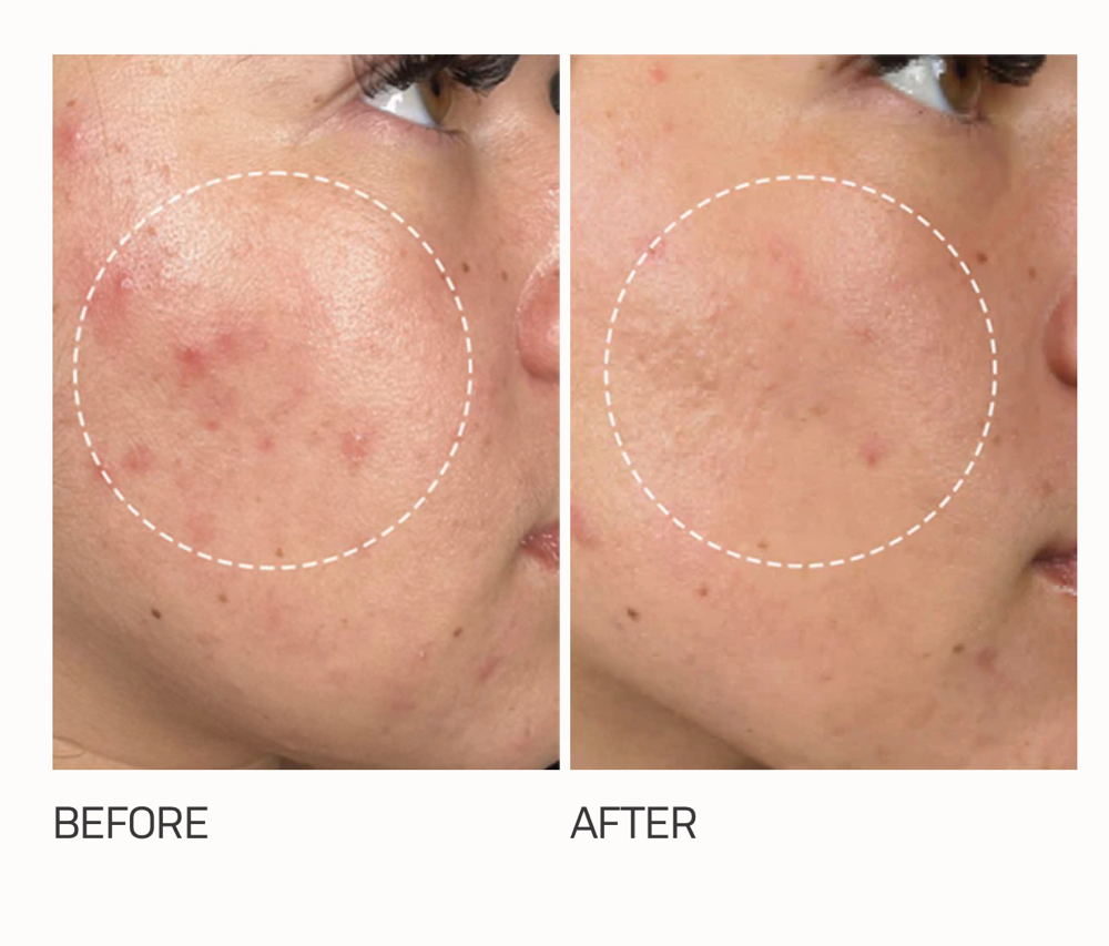 HydroFacial