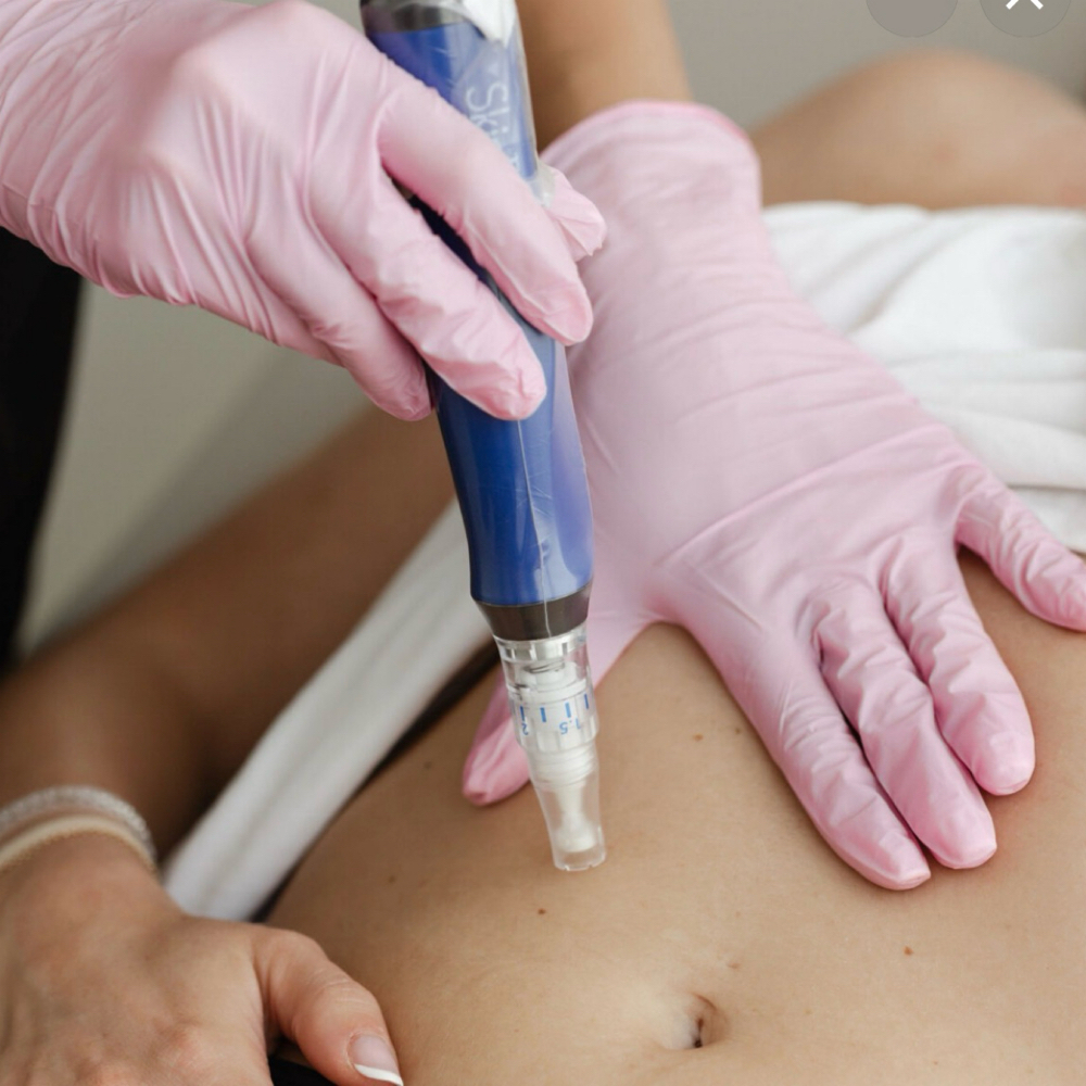 MicroNeedling Body