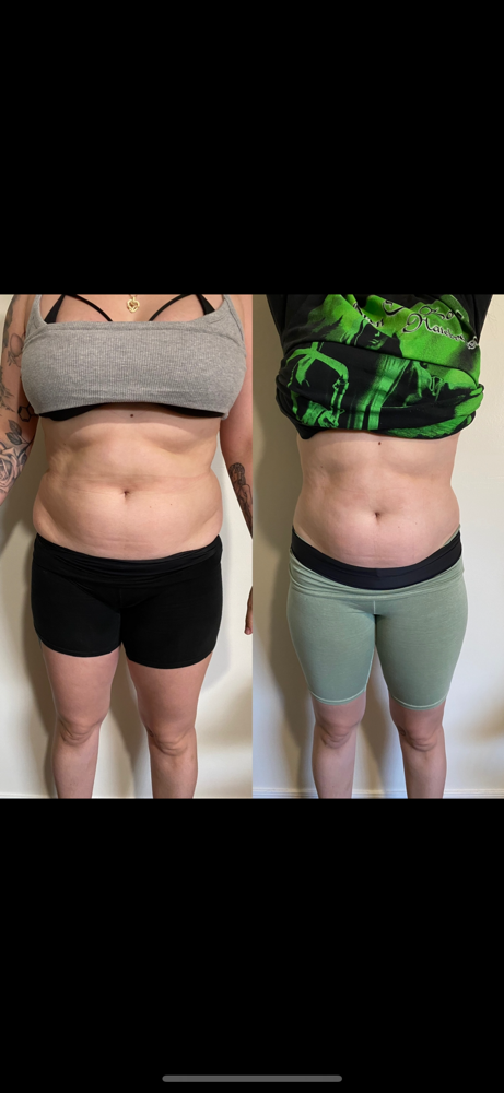 Body Contouring