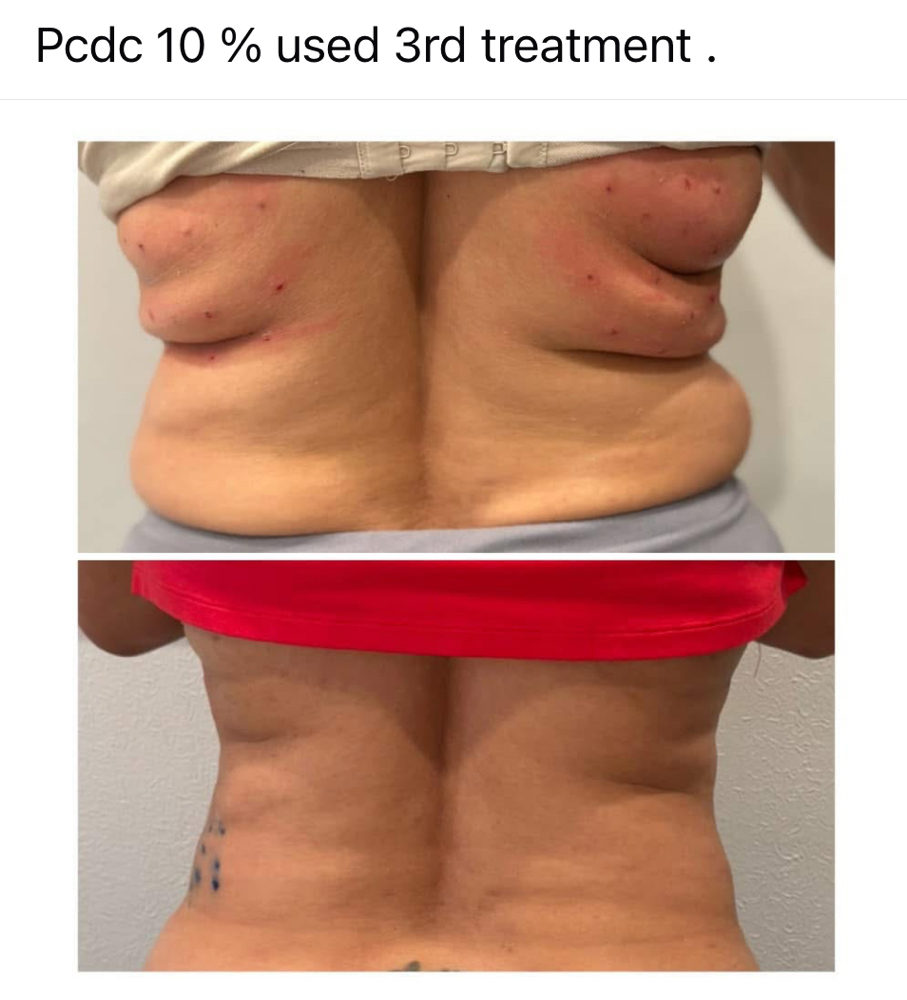 Lipo Dissolve PCDC at Unveiled Beauty Aesthetic Studio in Converse, TX