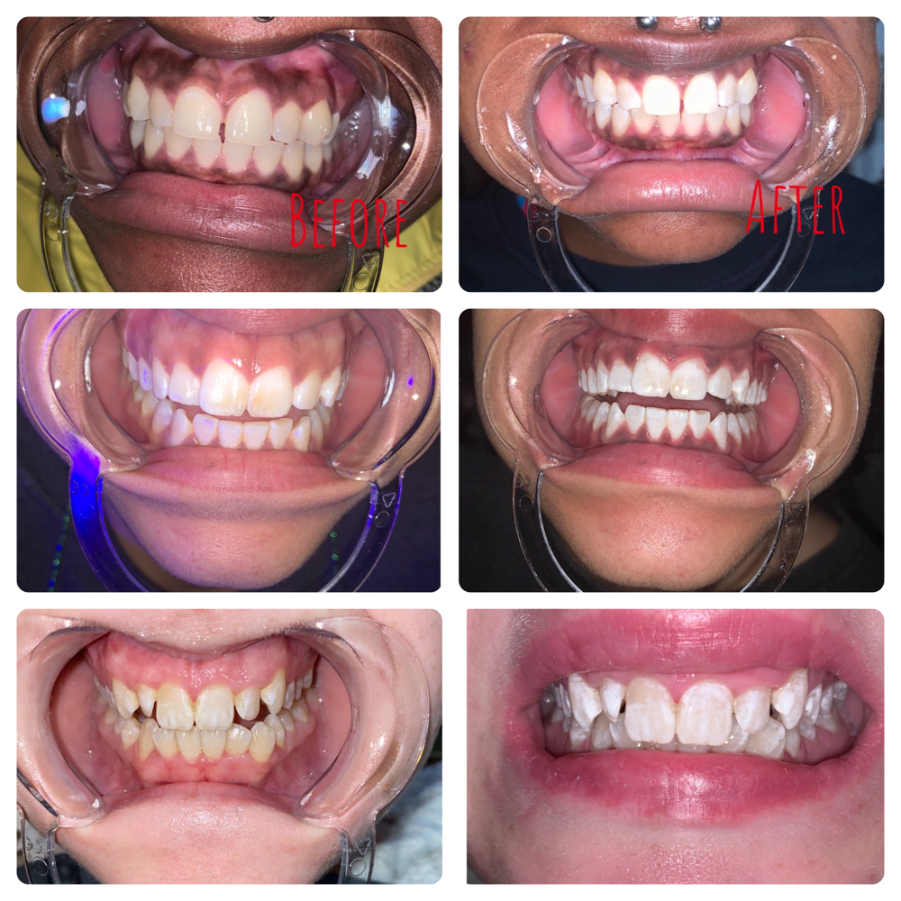 touchup teeth whitening at RJ Cosmetics in PONTOTOC, MS