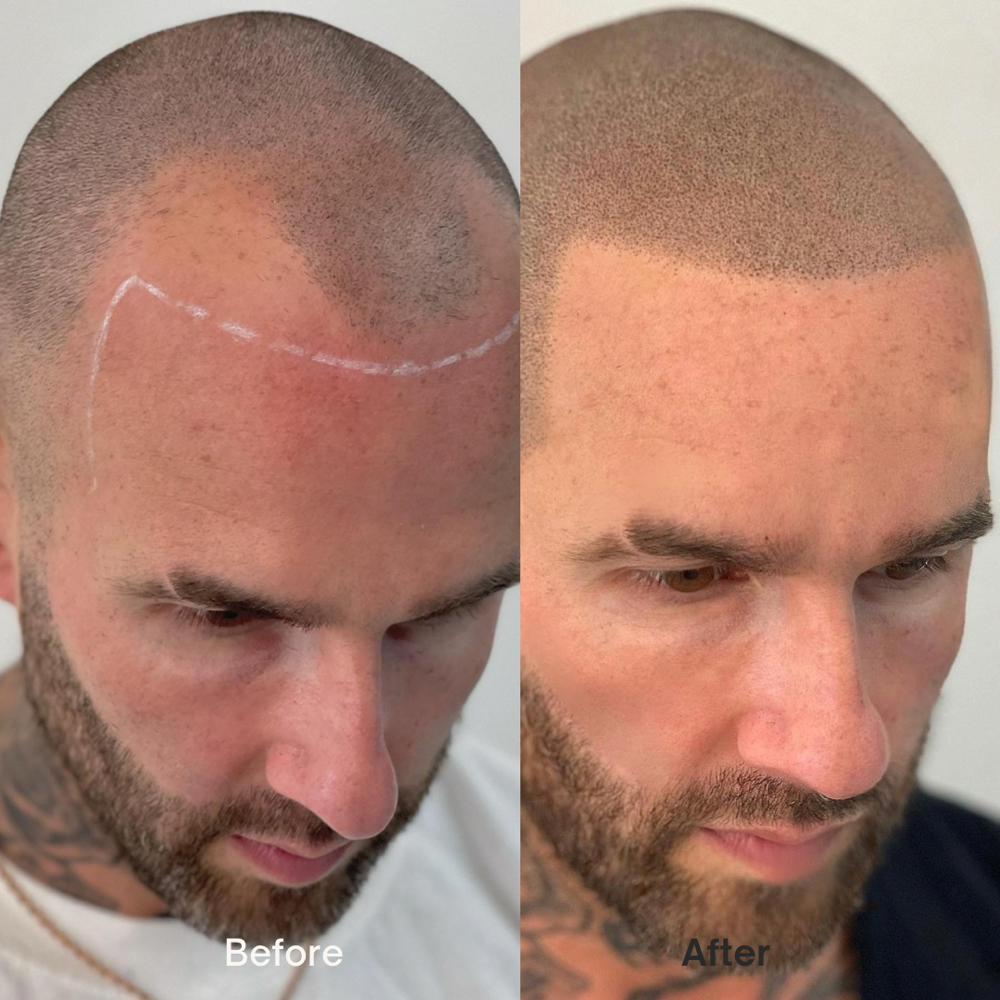 SCALP MICRO PIGMENTATION