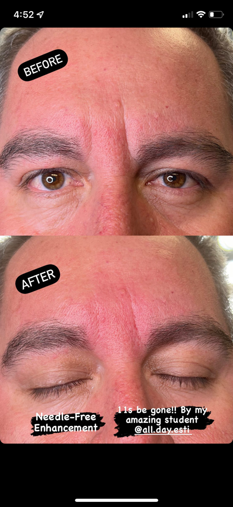 Hyaluronic Pen Enhancement