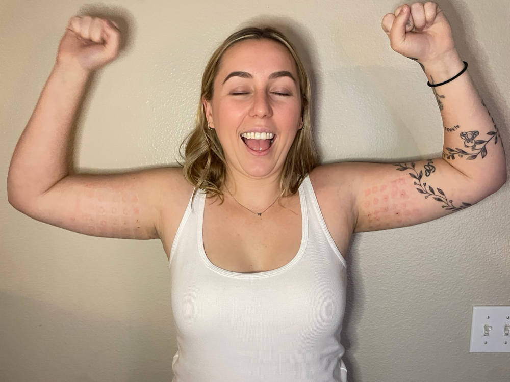 Fat Dissolve Arms.