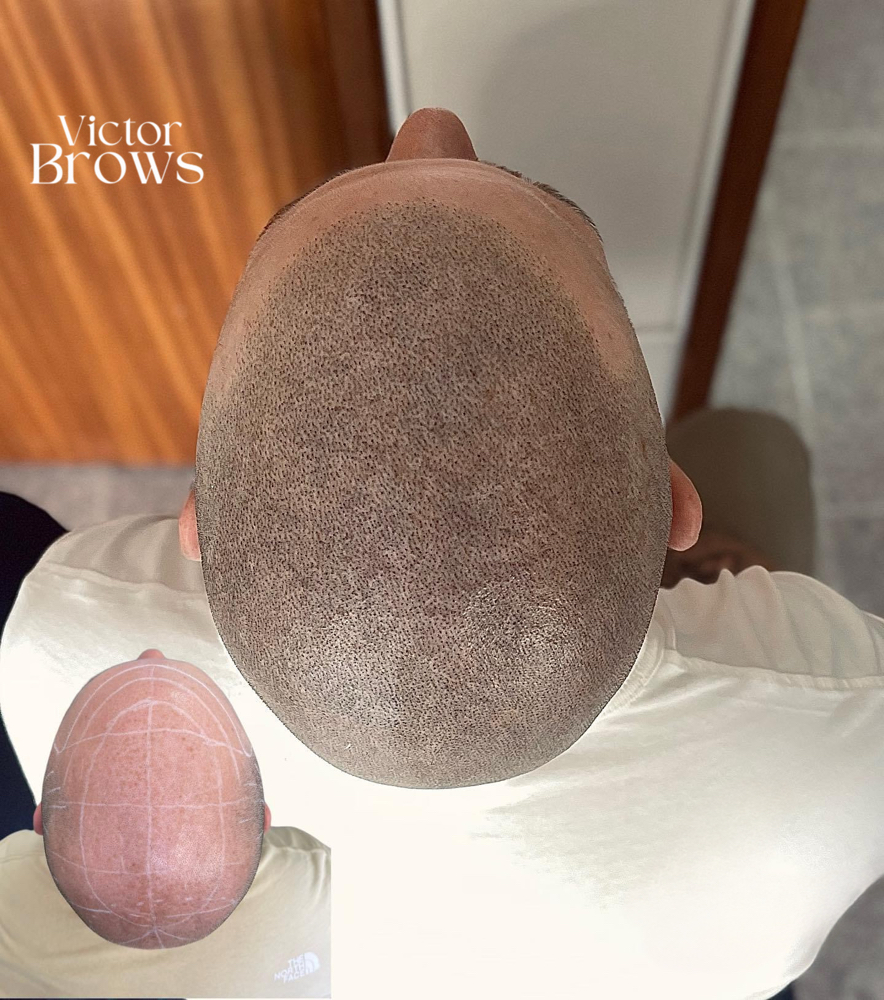 SCALP MICROPIGMENTATION