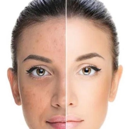 CHEMICAL PEEL at Luxury Prime RX | #303.919.0391 in Centennial, CO