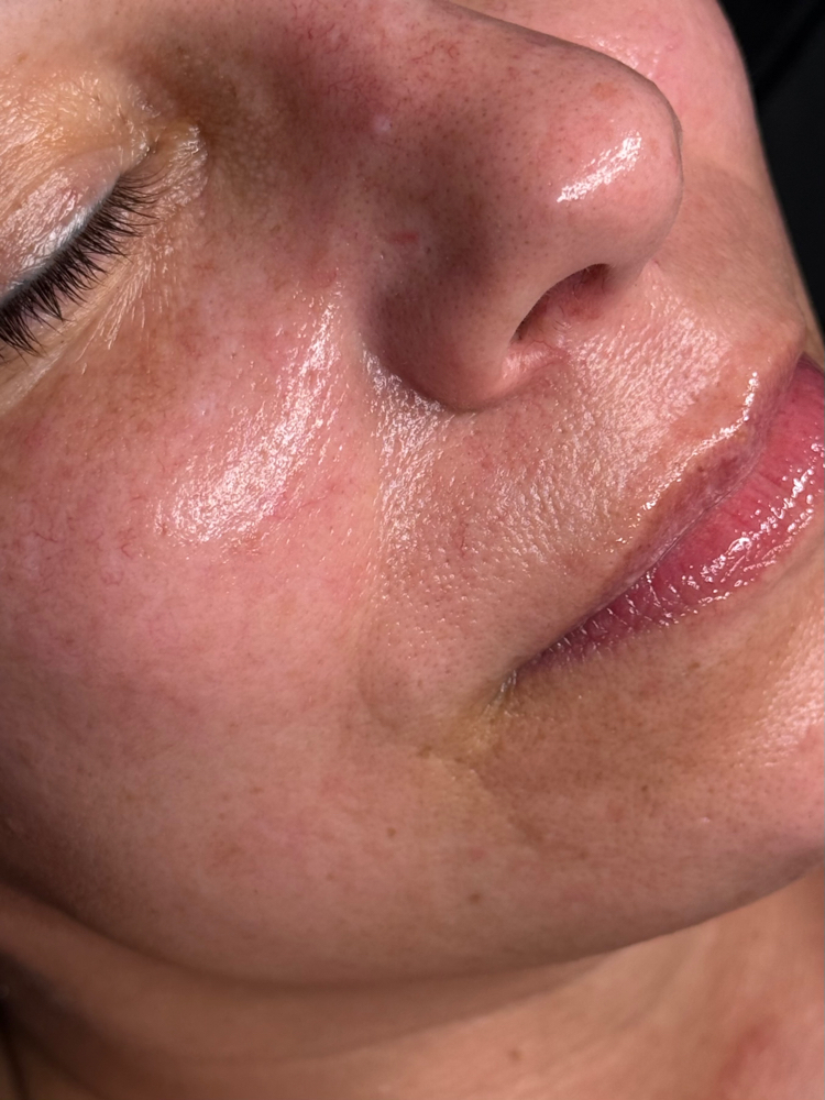 the custom chemical peel at Butler Skin in Sheridan, WY