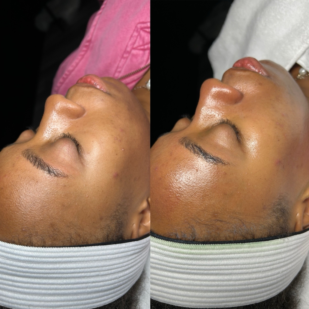 Microdermabrasion Facial