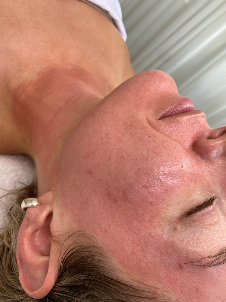 Corrective Needling