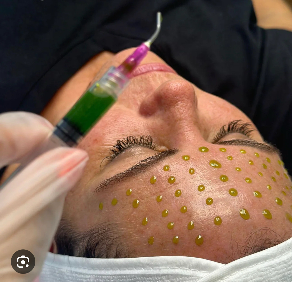 Radiant Glow Peels  Tca 8 Weeks