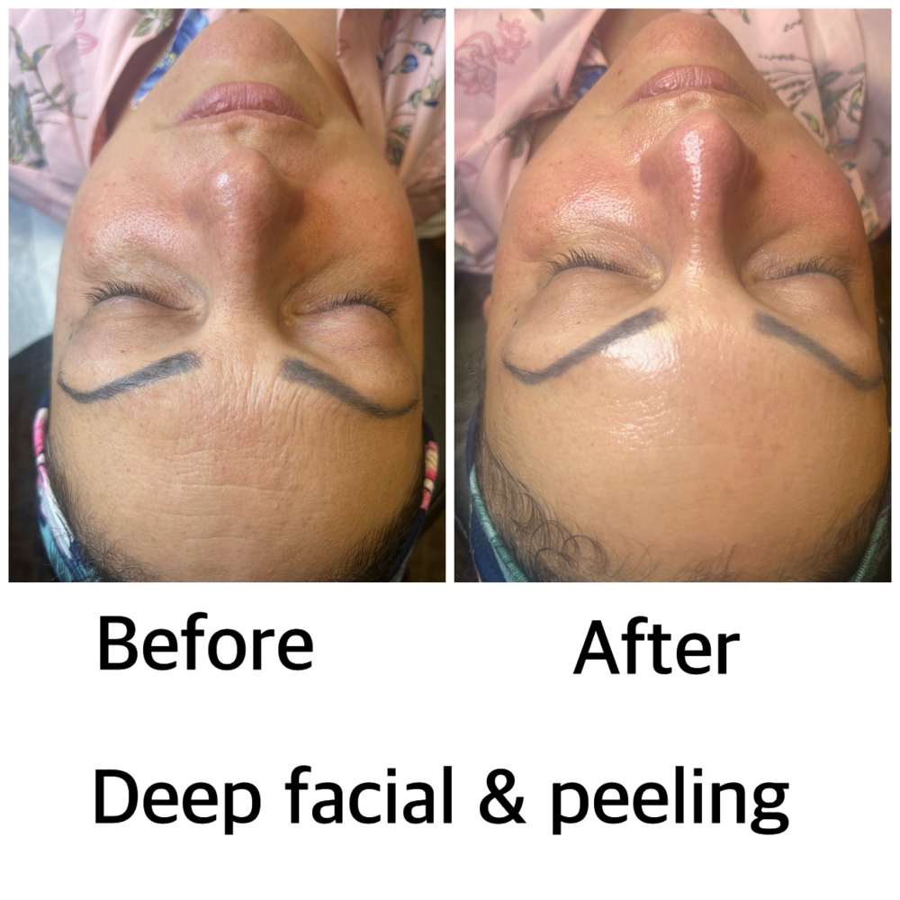 Deep clean Facial & Peeling