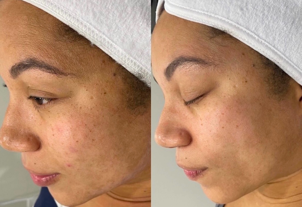 BioRePeel (No Peel Chemical Peel)