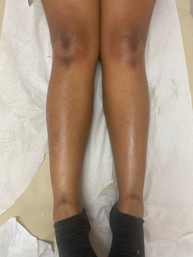 Lower Leg