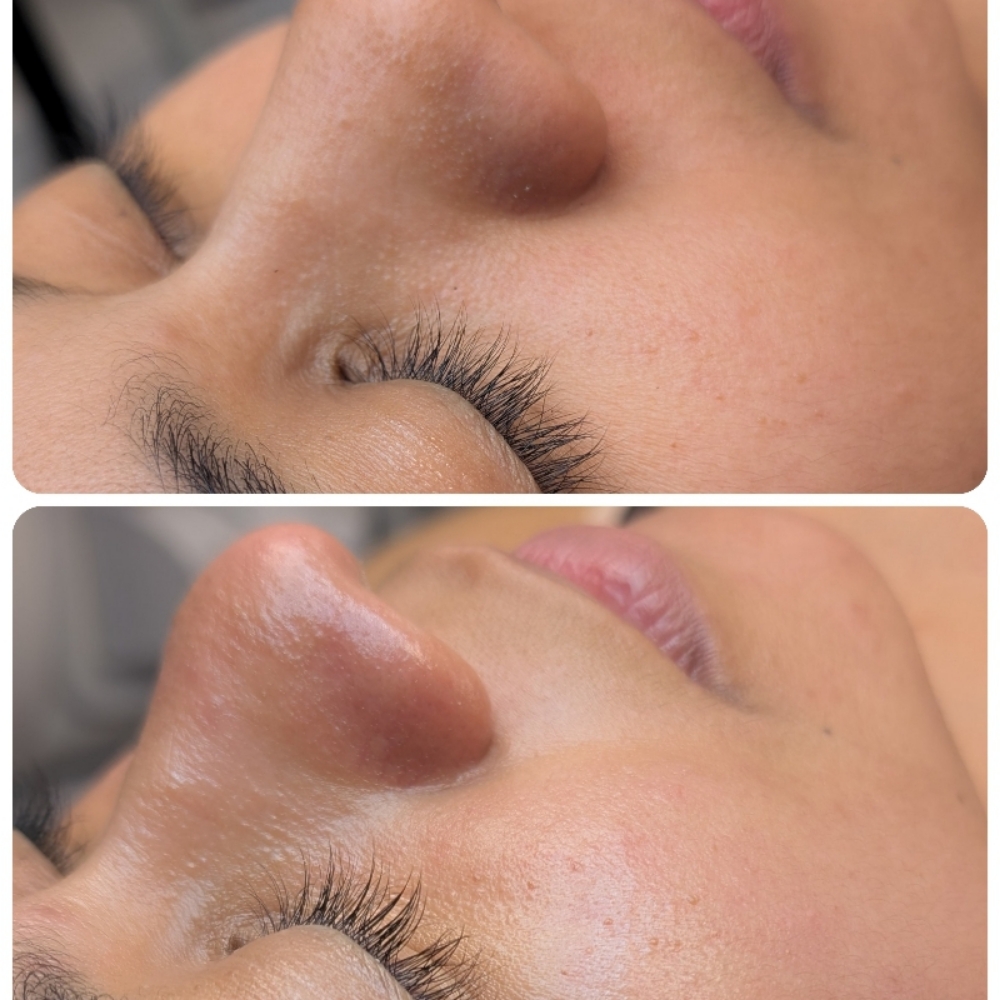 Glutathione Induction Therapy at Nenusk Aesthetics in Long Island City, NY