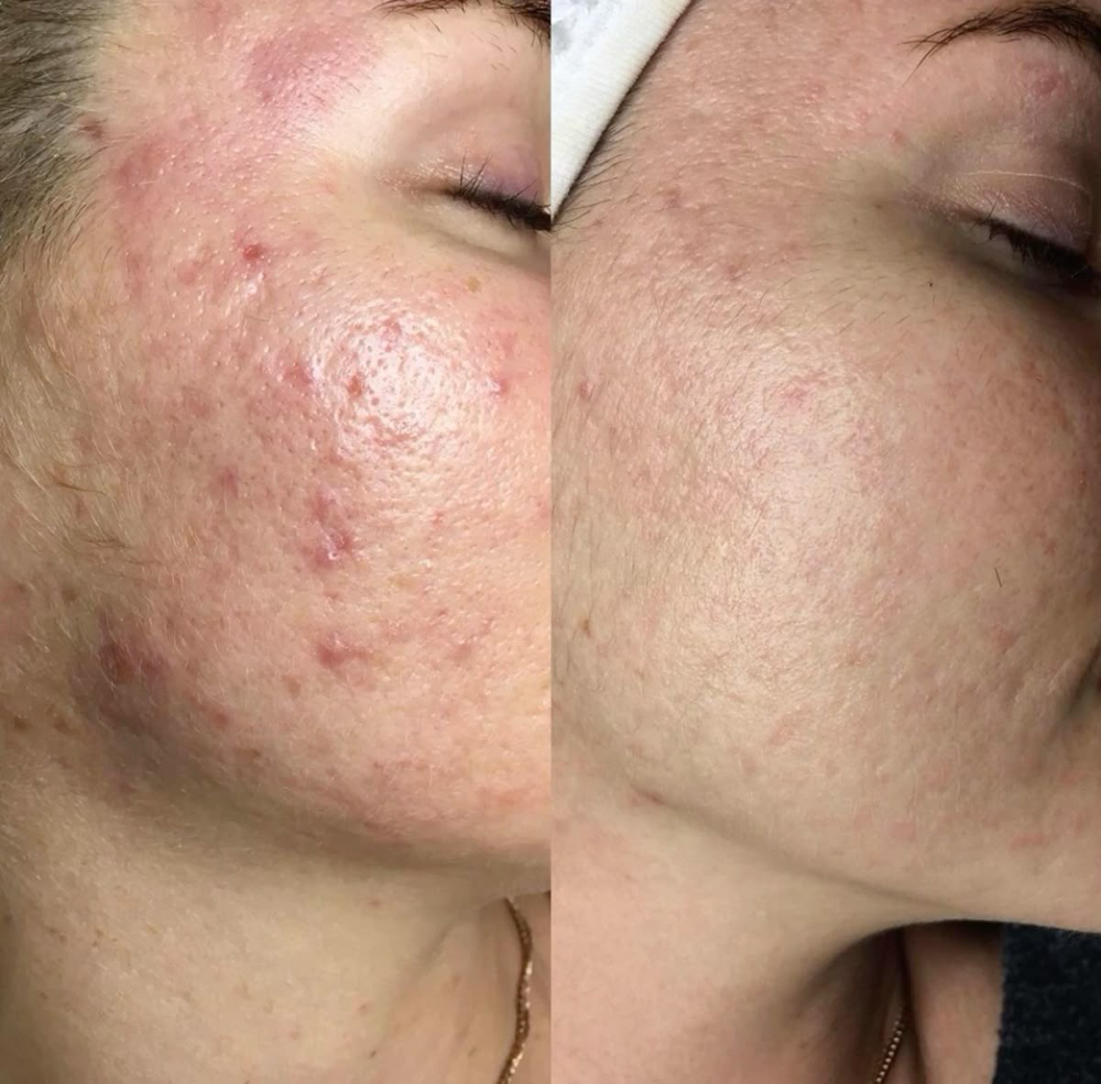 Acne Facial