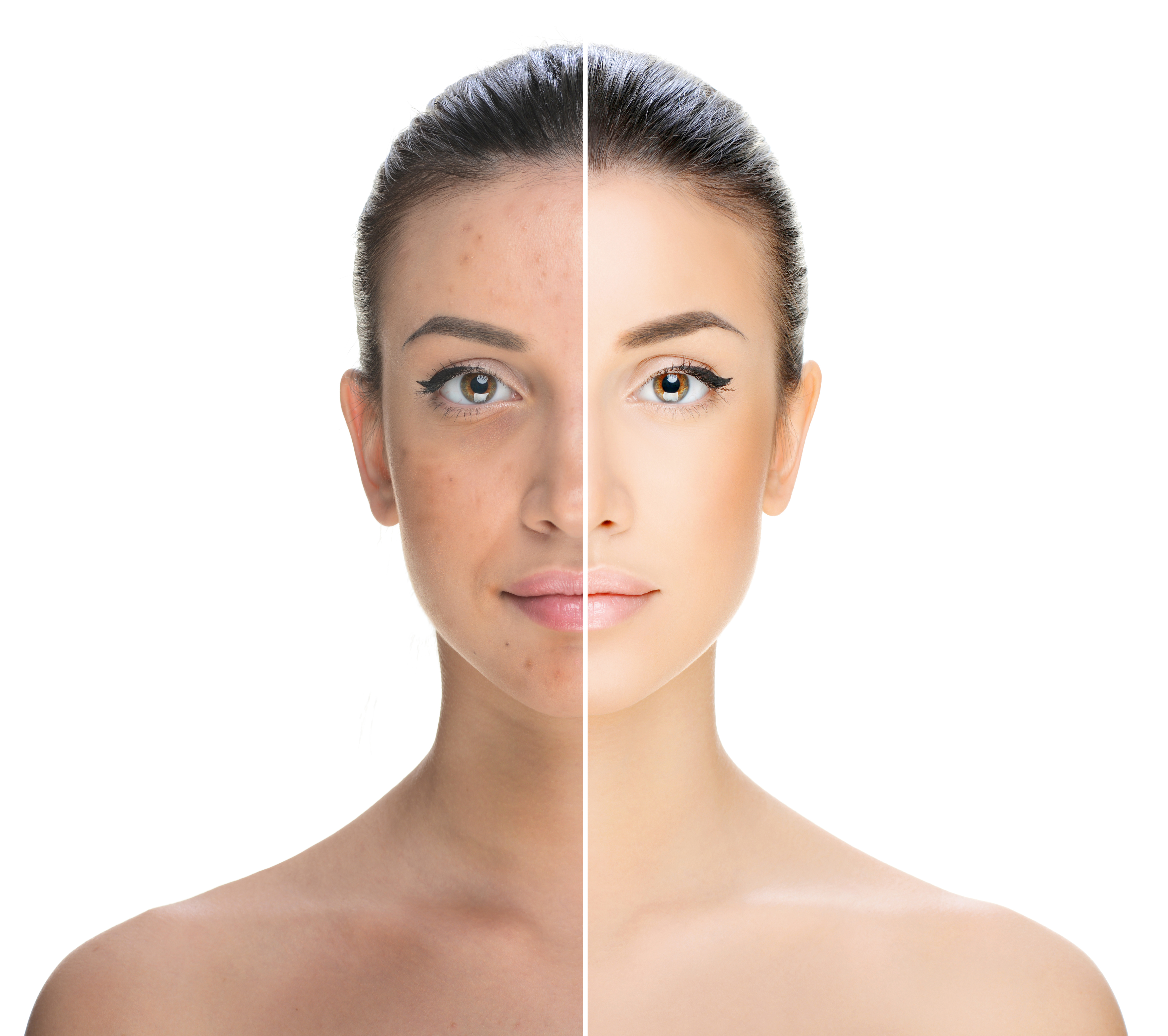 CLEARING ACNE FACIAL