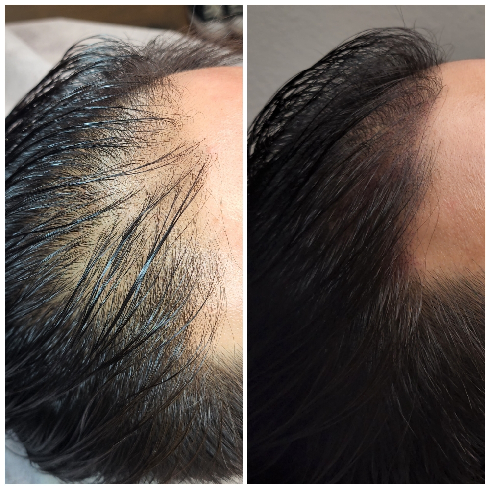 Scalp Micropigmentation/Tricopigmen