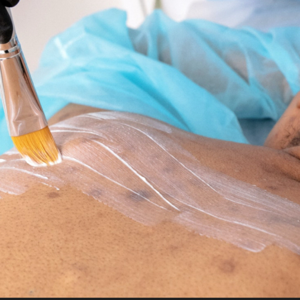 Detoxifying Back Treatment at Prestige Aesthetics KC in Independence, MO