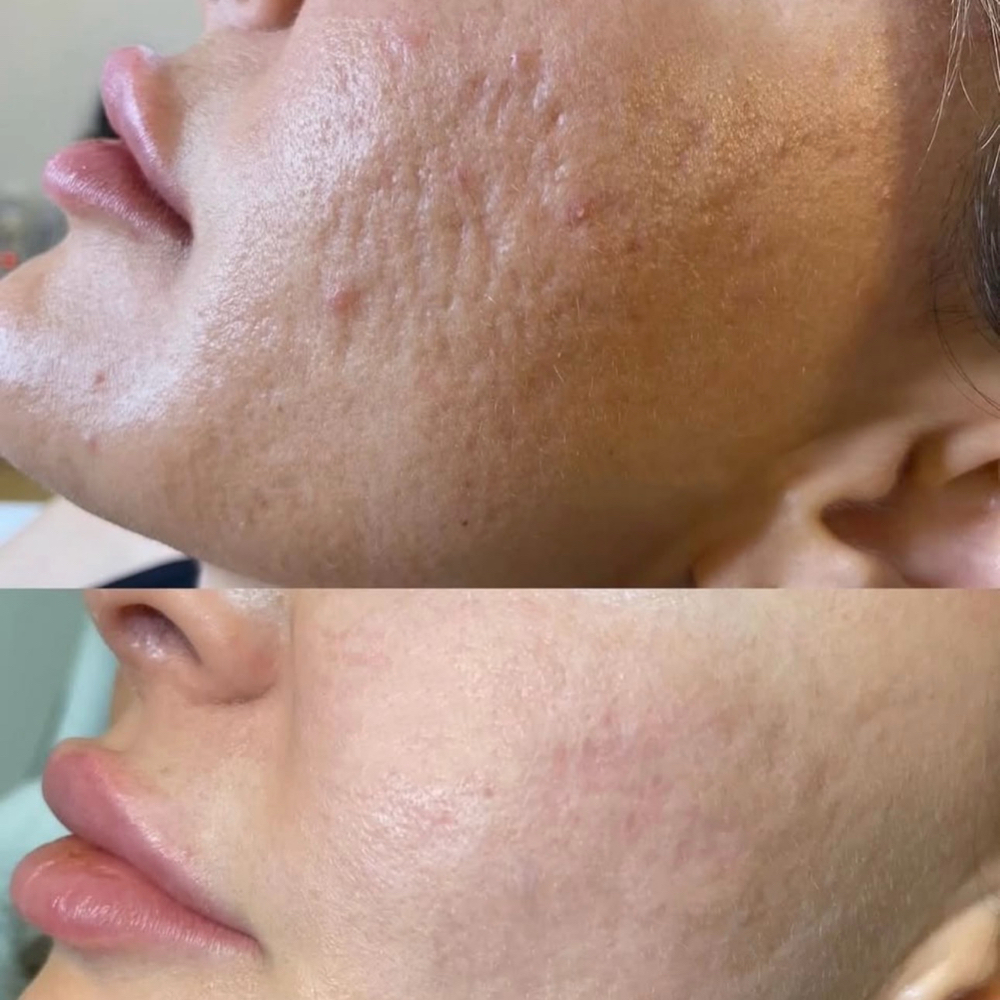 Acne Scar Revision at Balance.Bar.Aesthetics in Vallejo, CA