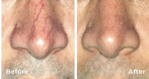 Facial Vein Reduction