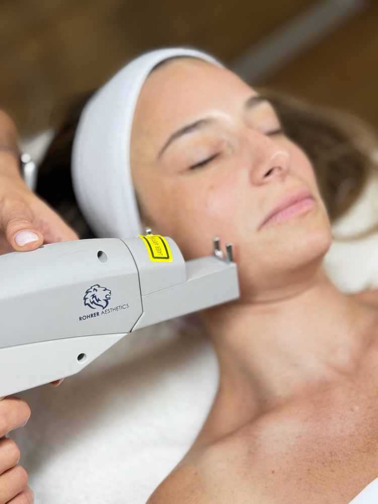 Facial Vein Reduction
