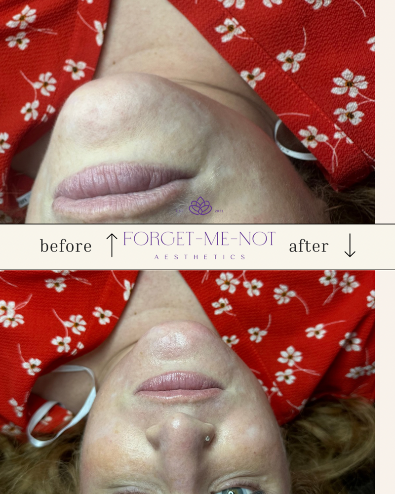 💉 Micro-Needling Lip & Perioral Tr at Forget-Me-Not Aesthetics in Garland, TX